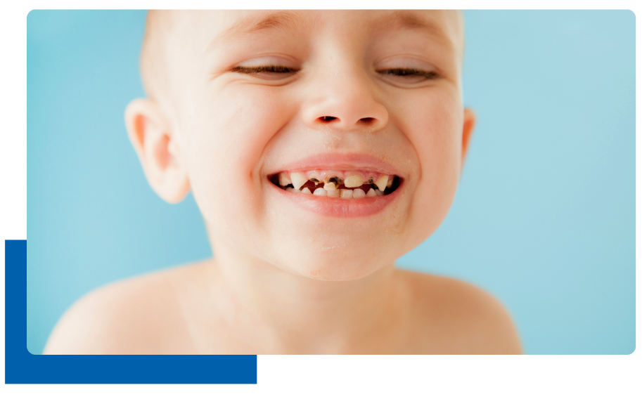 Decayed primary teeth in kids