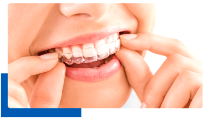 Best Invisalign treatment in Powai