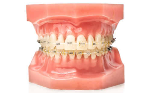 Ceramic Braces