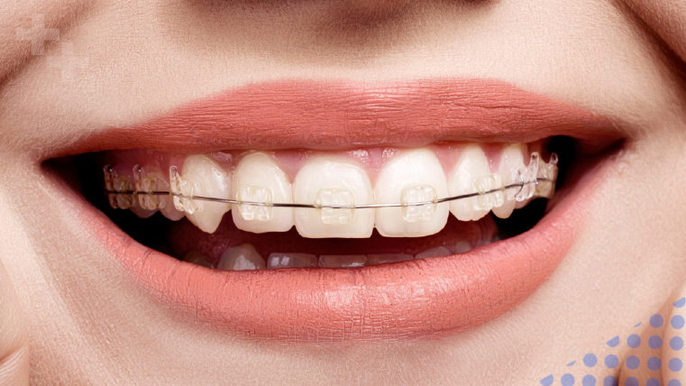 Ceramic braces treatment