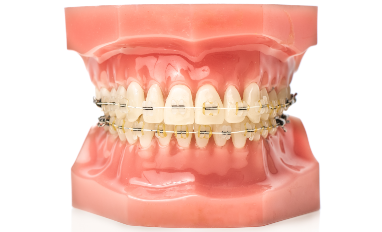 Ceramic Bracesligners