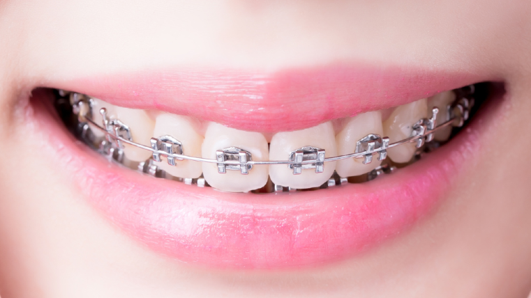 Metal Braces treatment near Andheri